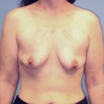 Breast Lift Before Patient Thumbnail 1