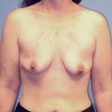 Breast Lift Before Patient 11