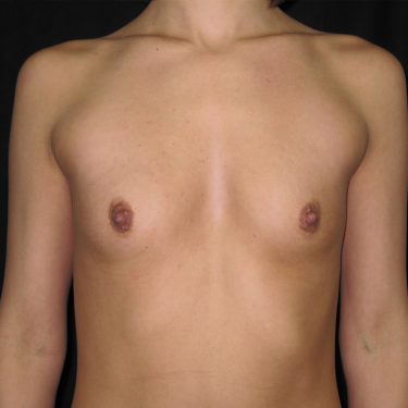 Breast Augmentation Before Patient 8