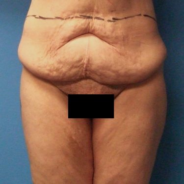Tummy Tuck Before Patient 10