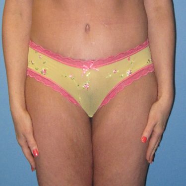 Tummy Tuck After Patient 10