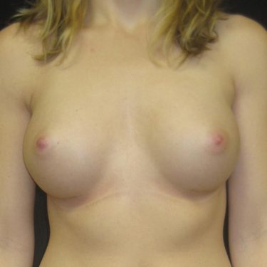 Breast Augmentation After Patient 22