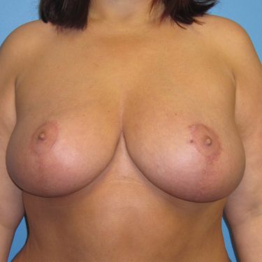 Breast Lift After Patient 10