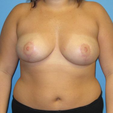 Breast Reduction After Patient 2