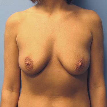 Breast Augmentation Before Patient 5