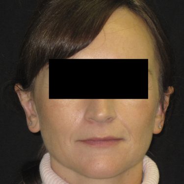 Ear Surgery After Patient 2