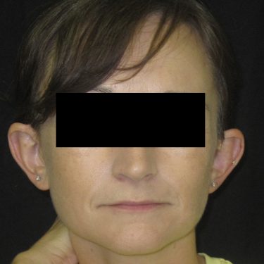 Ear Surgery Before Patient 2