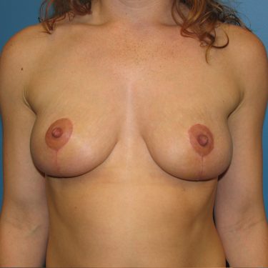 Breast Lift After Patient 8