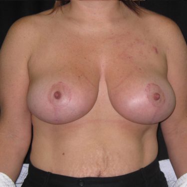 Breast Lift After Patient 7