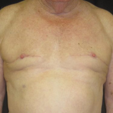 Gynecomastia Surgery After Patient 1