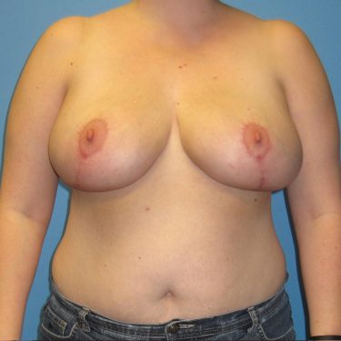 Breast Reduction After Patient 21