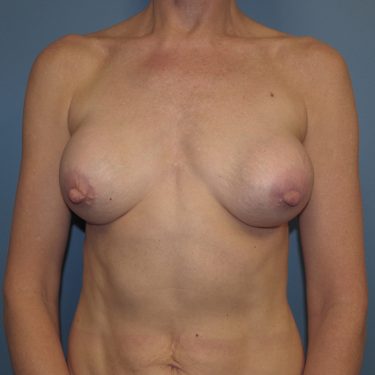 Breast Augmentation Before Patient 3