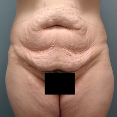 Tummy Tuck Before Patient 8