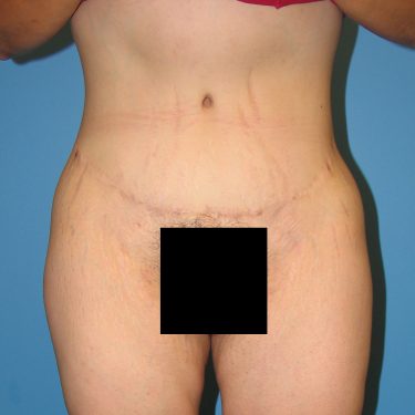 Tummy Tuck After Patient 8