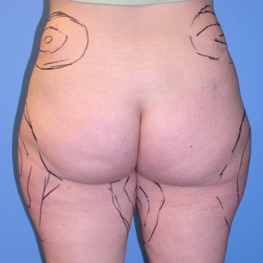 Liposuction Before Patient 3