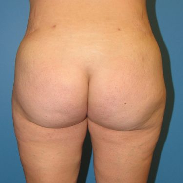 Liposuction After Patient 3
