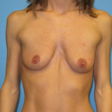 Pectus deformity Before Patient 2