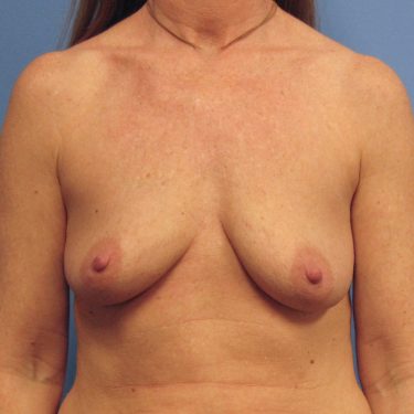 Breast Augmentation Before Patient 1