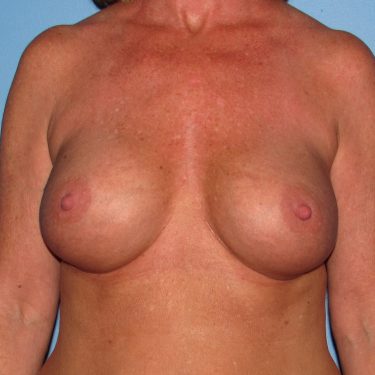 Breast Augmentation After Patient 1