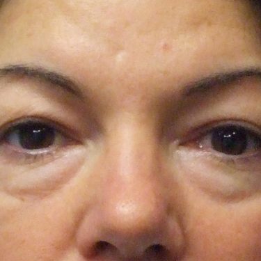 Eyes & Brow Before Patient 9