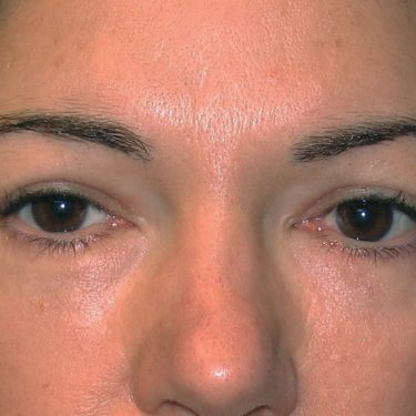Eyes & Brow After Patient 9