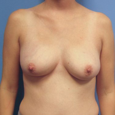 Dual-plane technique Before Patient 10