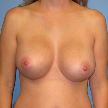 Dual-plane technique After Patient 10