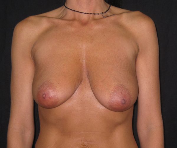 Breast Lift Before Patient 1