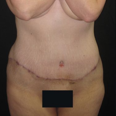 Body After Patient 28