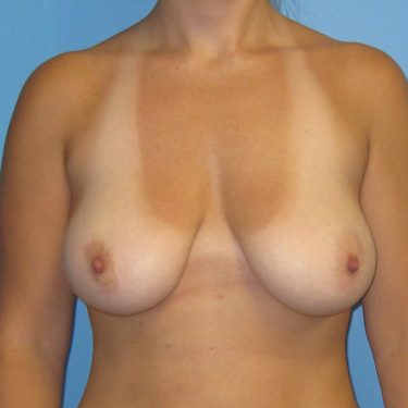 Breast Lift Before Patient 10