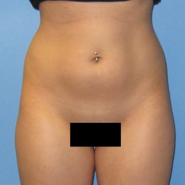Liposuction Before Patient 2