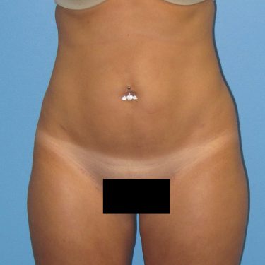 Liposuction After Patient 2
