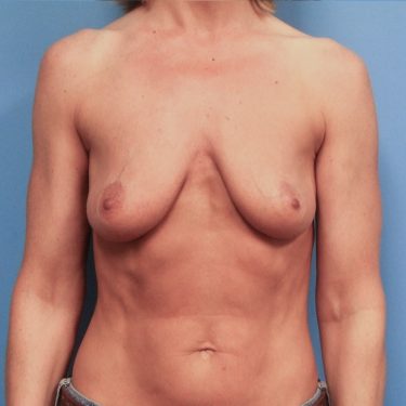 Breast Lift Before Patient 1