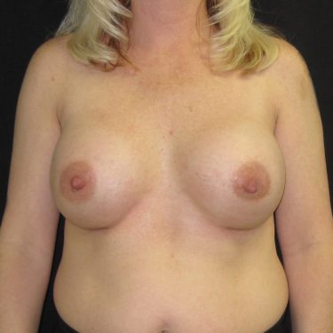 Revision of Others' Work After Patient 1