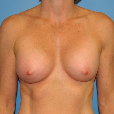 Revision of Others' Work Before Patient 3