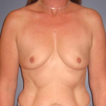 Breast Augmentation Before Patient 20
