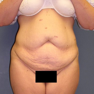 Tummy Tuck Before Patient 3