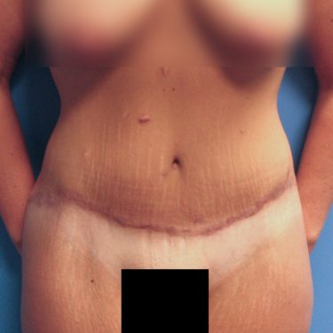 Tummy Tuck After Patient 3