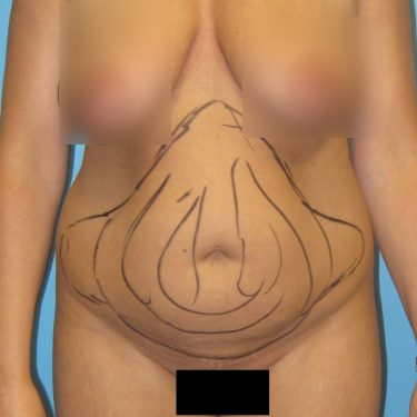 Liposuction Before Patient 1