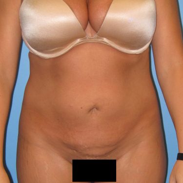 Liposuction After Patient 1