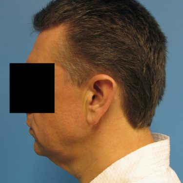 Neck Lift for Men Before Patient 1