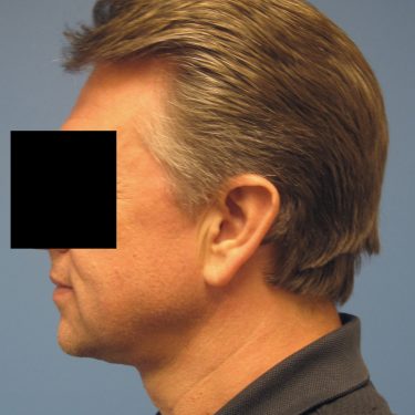 Neck Lift for Men After Patient 1