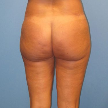 Liposuction After Patient 5
