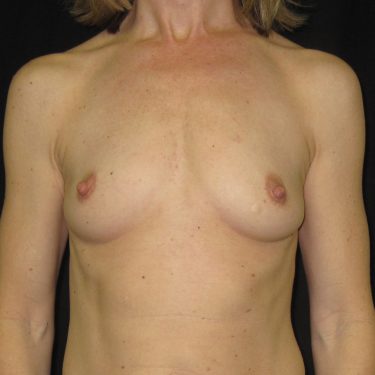 Subglandular Before Patient 11