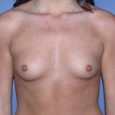 Breast Augmentation Before Patient 19