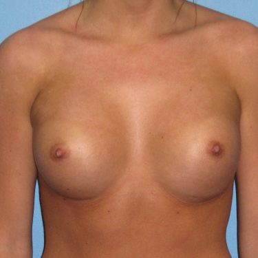 Breast Augmentation After Patient 19