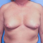 Breast Augmentation Before Patient Thumbnail 1