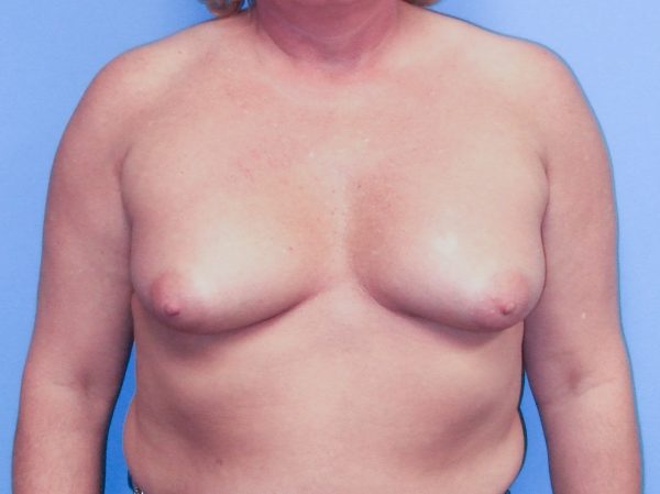 Breast Augmentation Before Patient 1