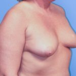 Breast Augmentation Before Patient Thumbnail 2