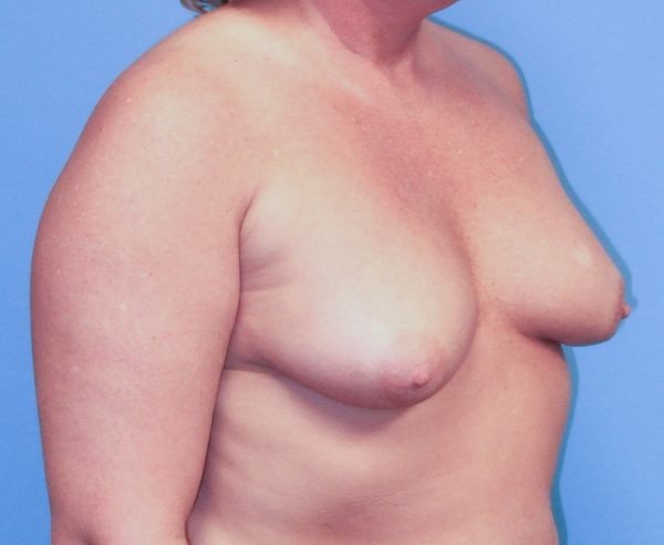 Breast Augmentation Before Patient 2